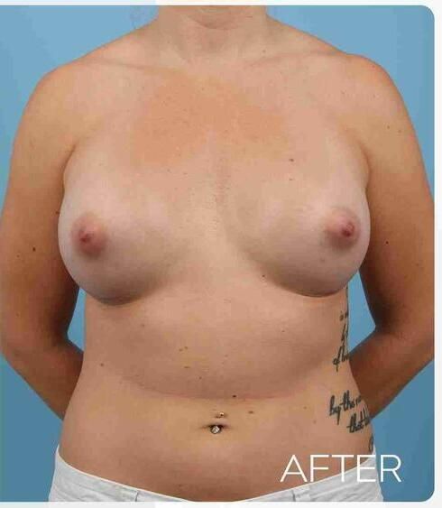 Breast Augmentation Before & After