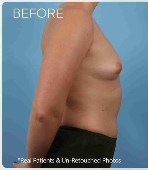 Breast Augmentation Before & After