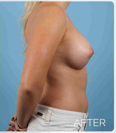 Breast Augmentation Before & After
