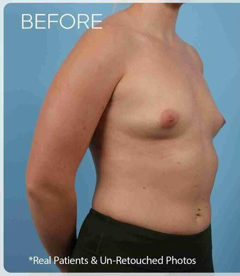 Breast Augmentation Before & After