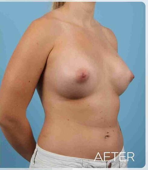Breast Augmentation Before & After