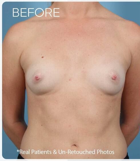 Breast Augmentation Before & After