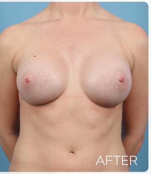 Breast Augmentation Before & After
