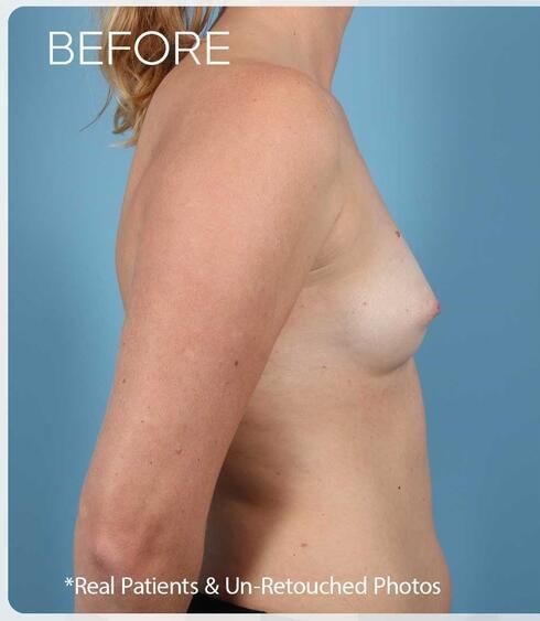 Breast Augmentation Before & After