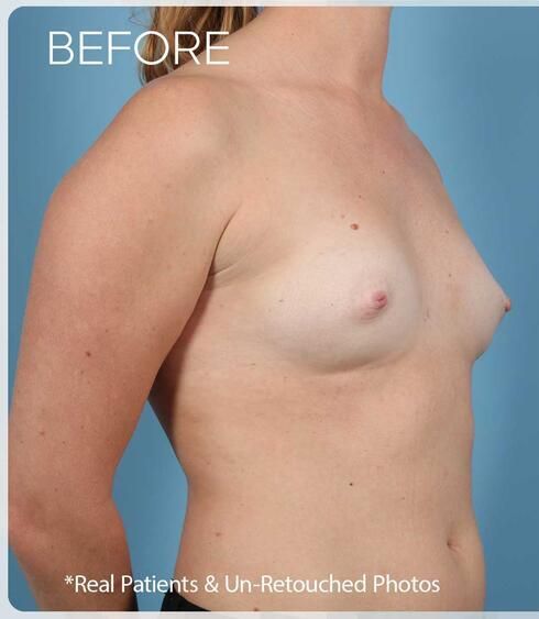 Breast Augmentation Before & After