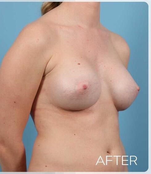 Breast Augmentation Before & After
