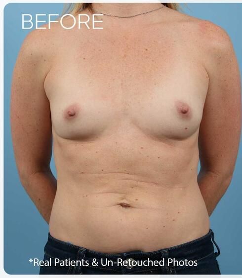 Breast Augmentation Before & After