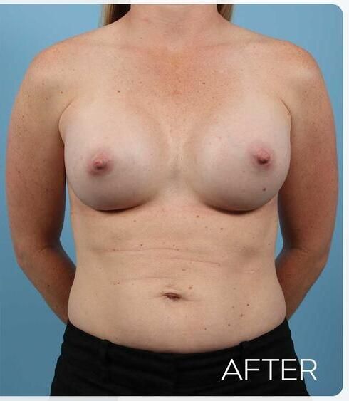 Breast Augmentation Before & After
