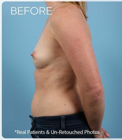 Breast Augmentation Before & After