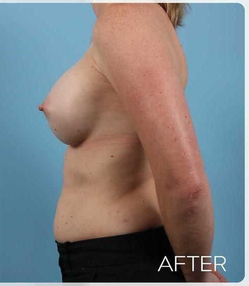 Breast Augmentation Before & After
