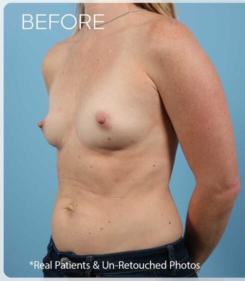 Breast Augmentation Before & After