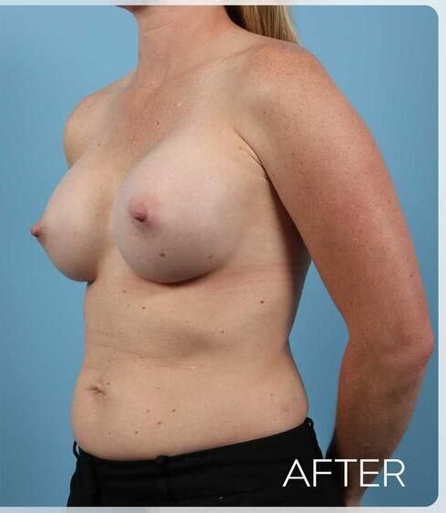 Breast Augmentation Before & After