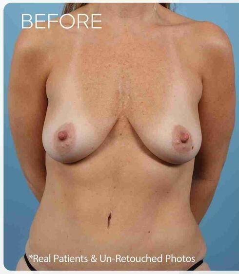 Breast Augmentation Before & After