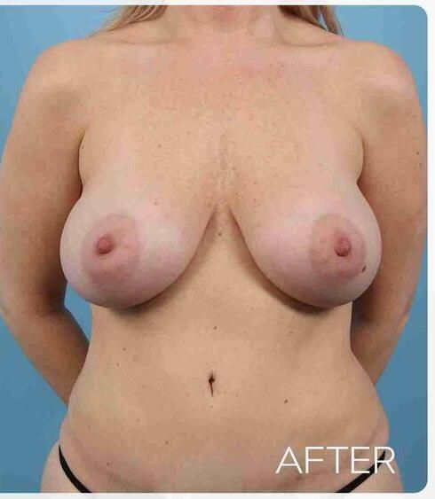 Breast Augmentation Before & After
