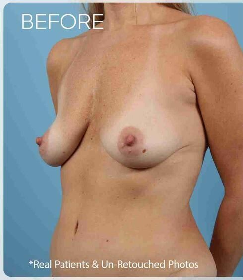 Breast Augmentation Before & After