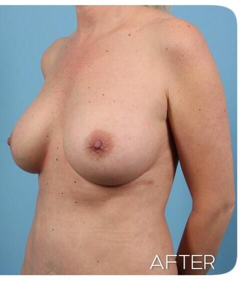 Breast Augmentation Before & After