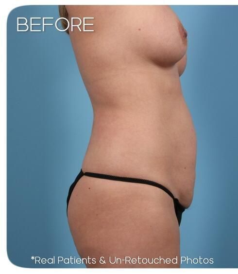Breast Augmentation Before & After