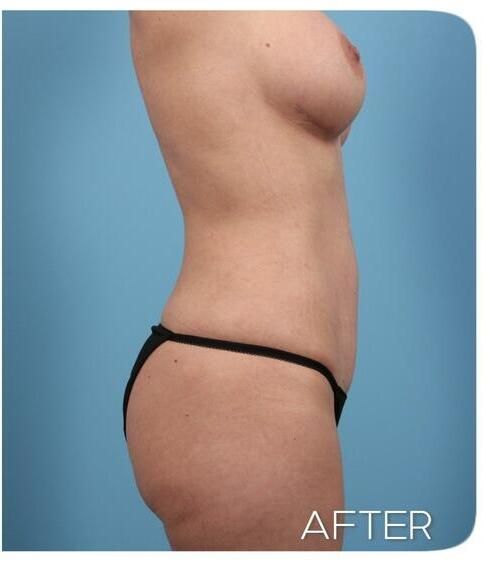 Breast Augmentation Before & After