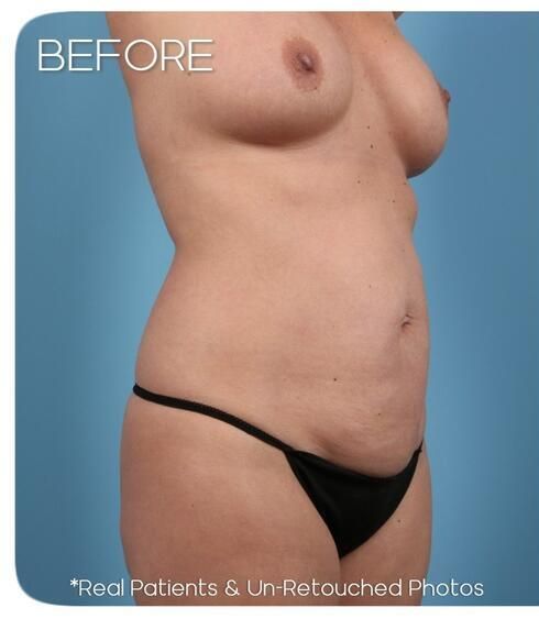 Breast Augmentation Before & After