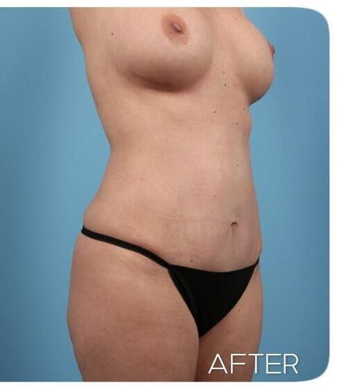 Breast Augmentation Before & After