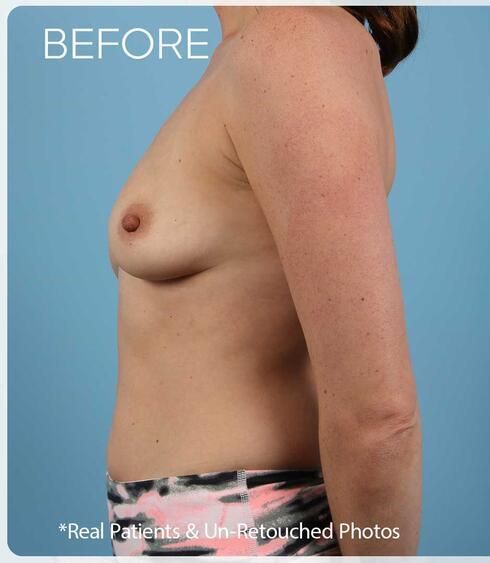 Breast Augmentation Before & After