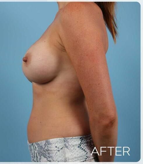 Breast Augmentation Before & After