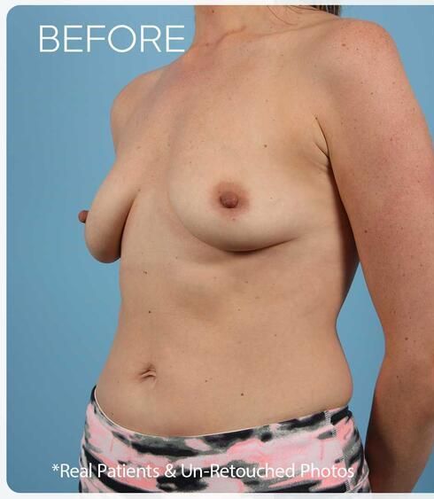 Breast Augmentation Before & After