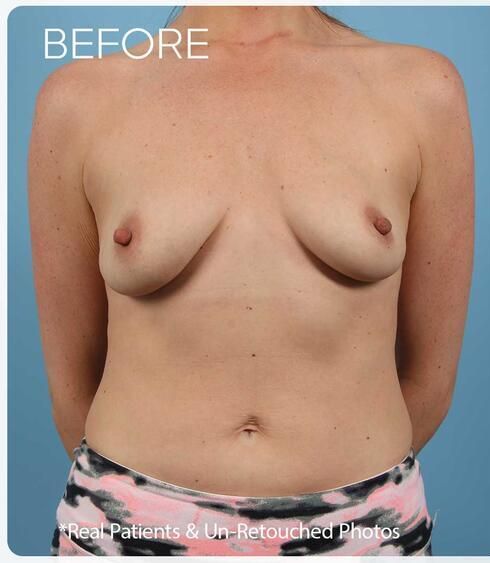 Breast Augmentation Before & After