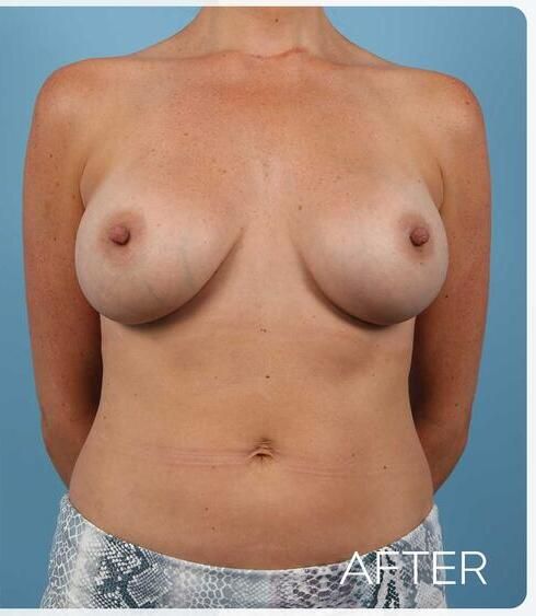 Breast Augmentation Before & After