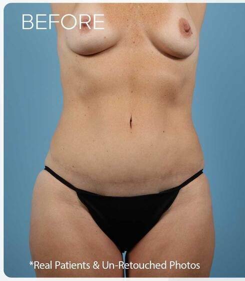Breast Augmentation Before & After