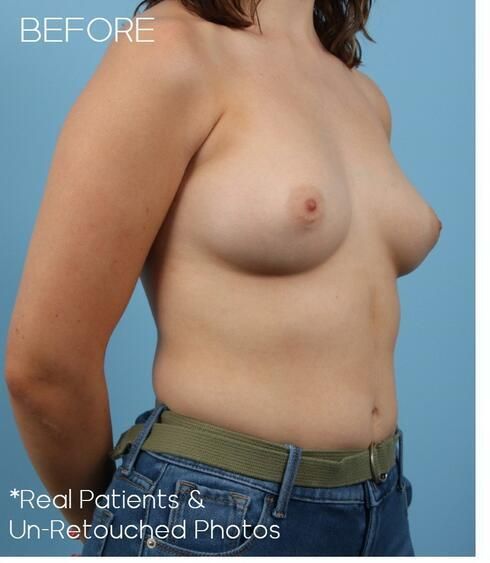 Breast Augmentation Before & After