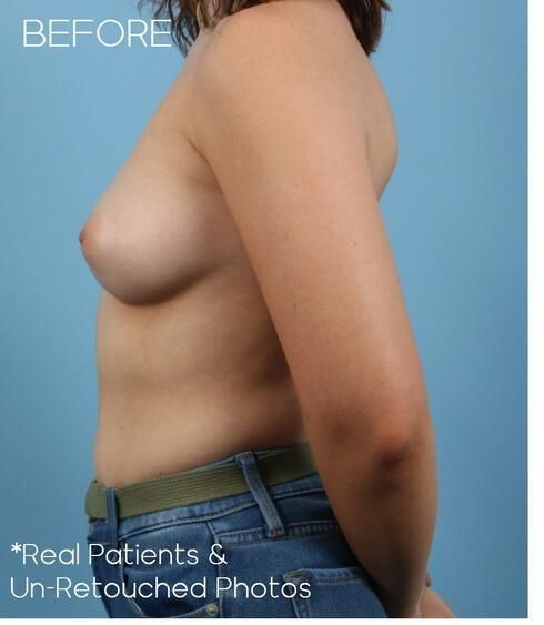 Breast Augmentation Before & After