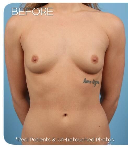 Breast Augmentation Before & After