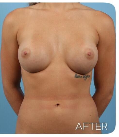 Breast Augmentation Before & After