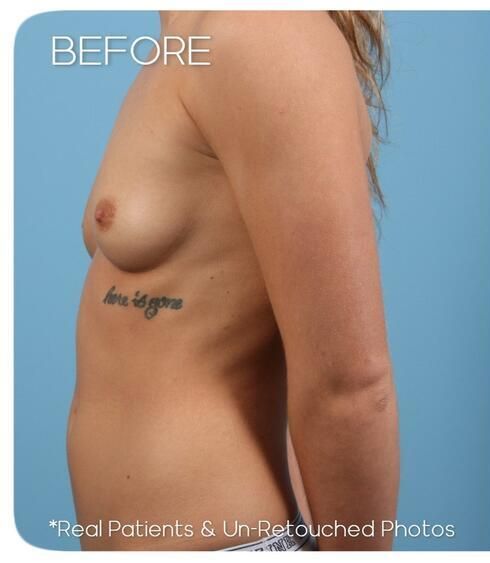 Breast Augmentation Before & After