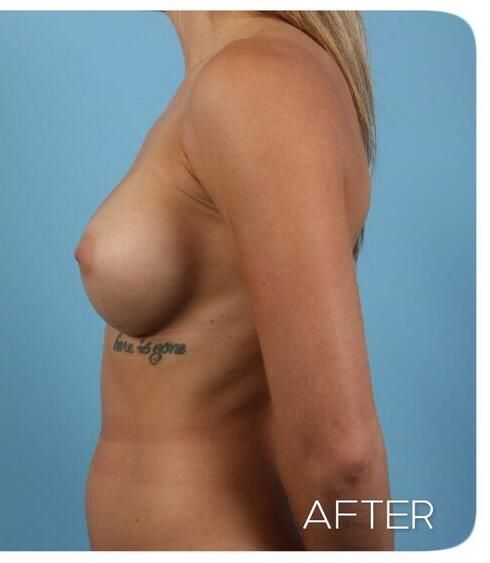 Breast Augmentation Before & After