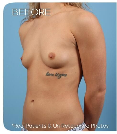 Breast Augmentation Before & After