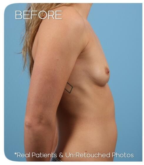 Breast Augmentation Before & After
