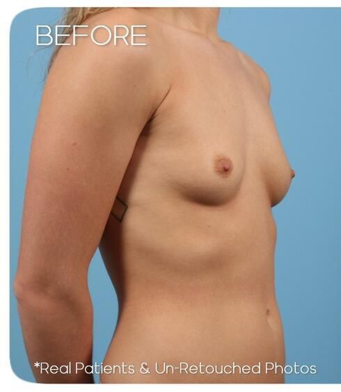 Breast Augmentation Before & After