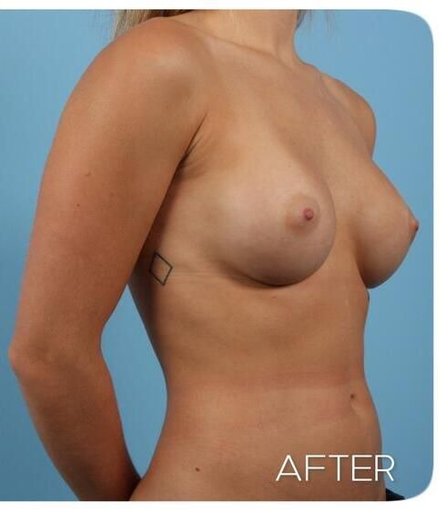 Breast Augmentation Before & After