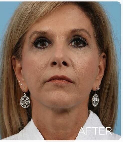 Facelift Before & After