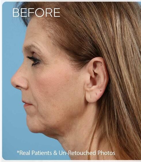 Facelift Before & After
