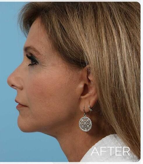 Facelift Before & After