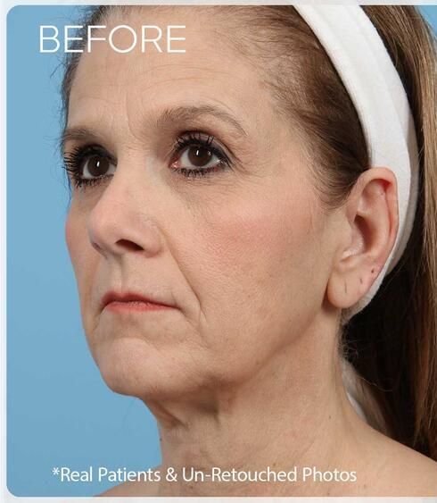 Facelift Before & After