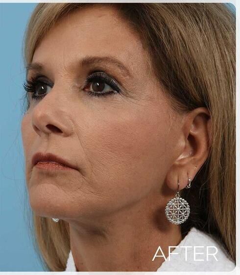 Facelift Before & After