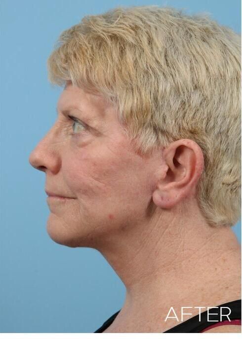 Facelift Before & After