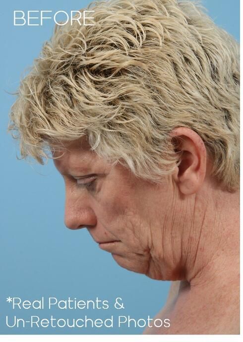 Facelift Before & After