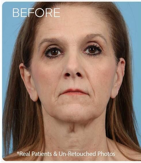 Facelift Before & After