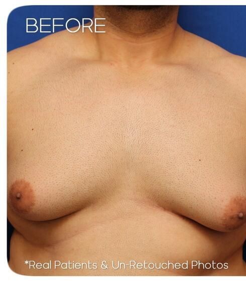 Gynecomastia Before & After