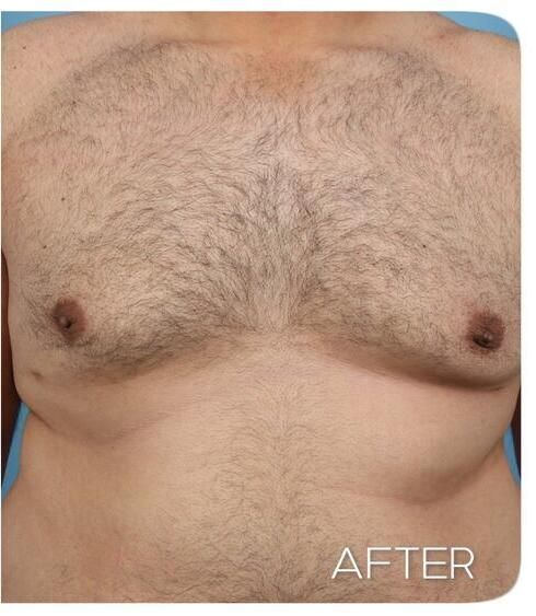 Gynecomastia Before & After